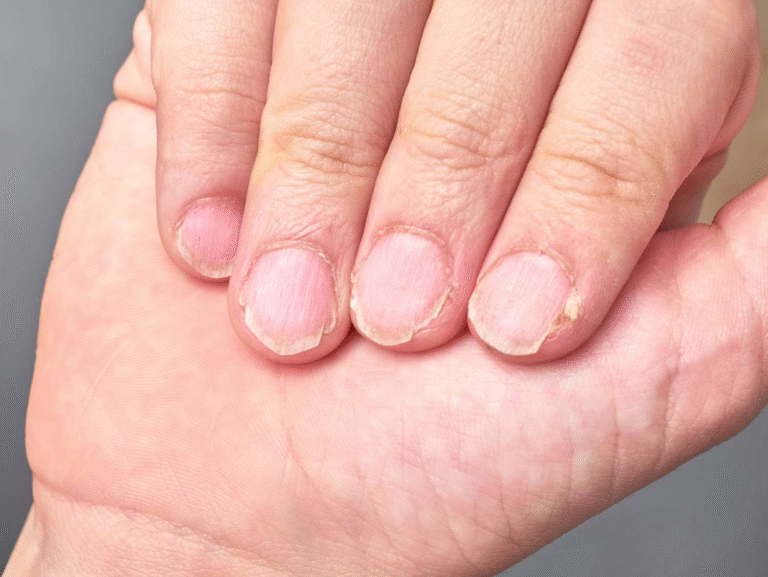 Common Nail Problems